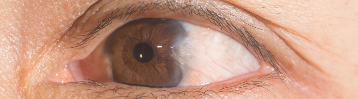 close up of the advance pterygium during eye examination