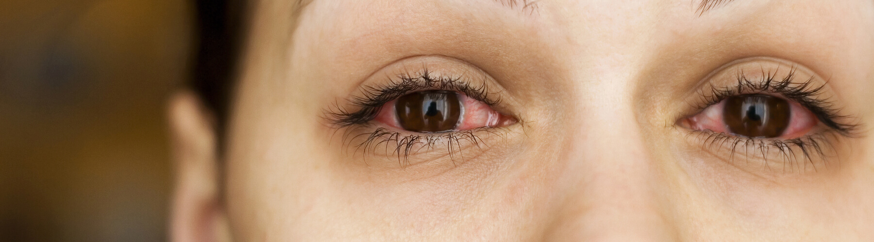 female eyes with conjunctivitis or pink eye