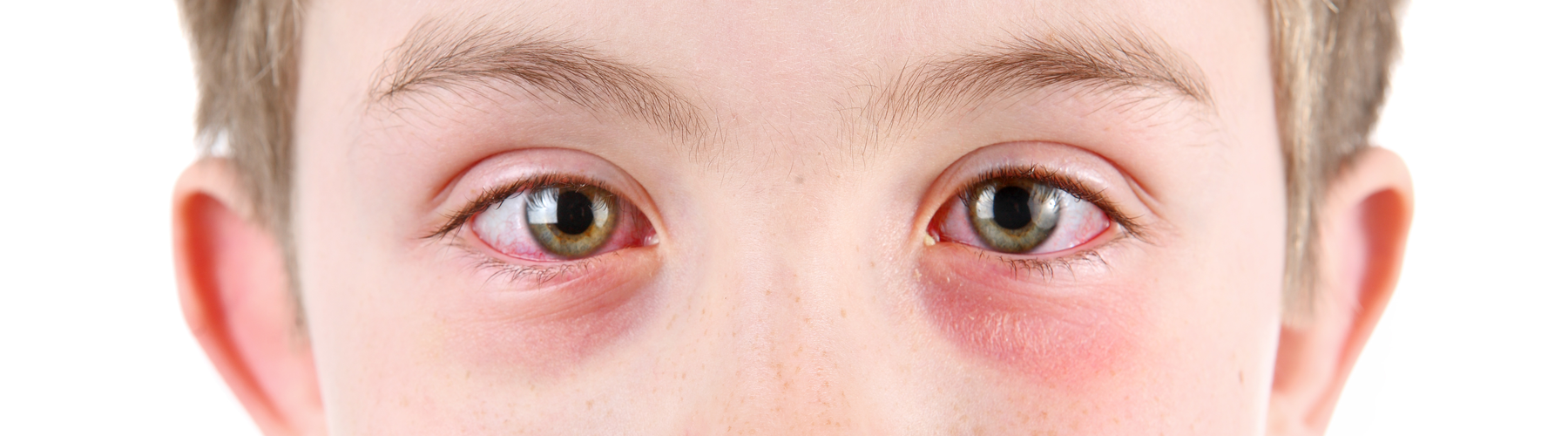Young boy with an eye infection
