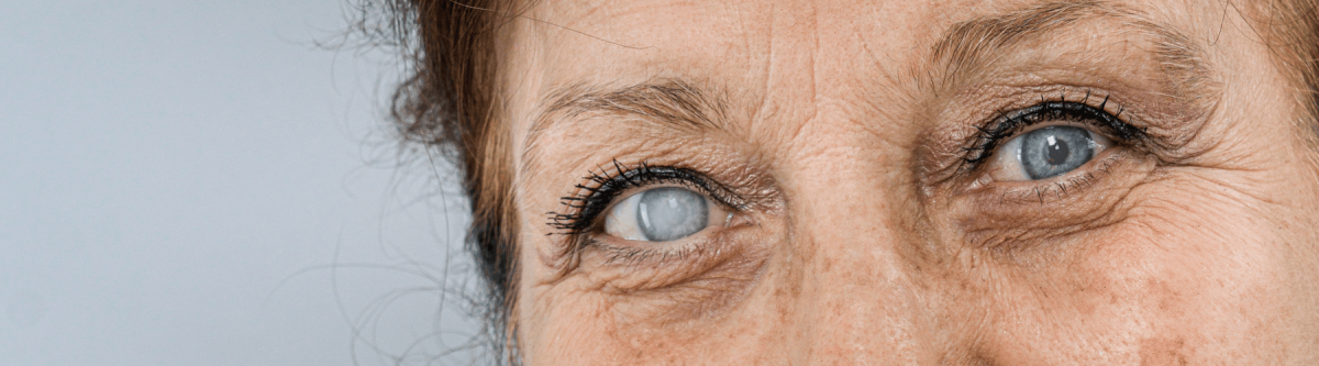 Close-up of a senior or elderly woman with cataracts. 