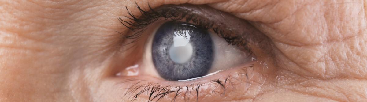 Closeup of a senior woman's cloudy eye, cataract concept cloudy lens