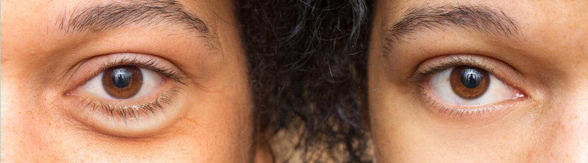 Before and after surgery comparison of a the area around a woman's eyes